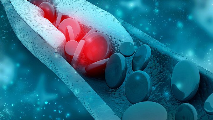 PI Ceramic - Kardiovaskuläre Eingriffe