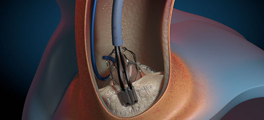 AorticLab Gemini transcatheter using a piezo-induced pairpitch technology